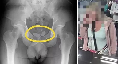 Röntgende ortaya çıktı! Uyuşturucuyu prezervatiflerin içine koyup cinsel organına gizlemiş